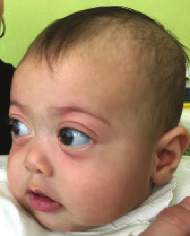 Dysmorfia
strednej
časti tváre,
plytké orbity,
pseudoexoftalmus,
hypertelorizmus
a nízky
koreň nosa
u pacientky
s Marshall/
Sticklerovým
syndrómom vo
veku 4 mesiacov