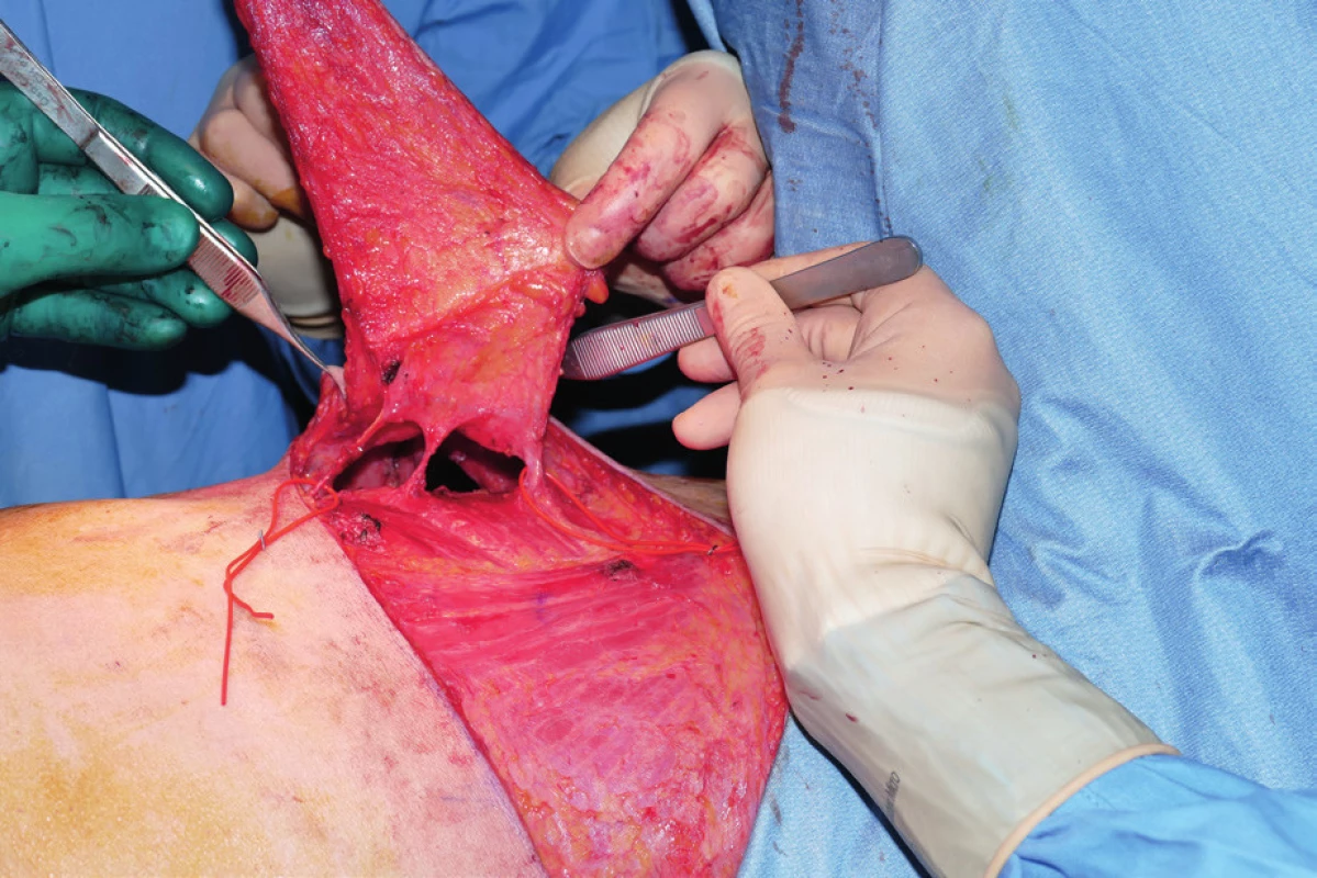 Flap harvested on three perforators of the lateral intercostal
artery