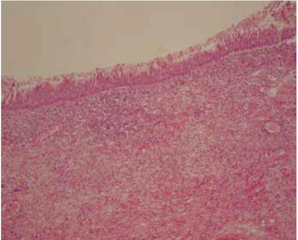 Oedema and inflammatory infiltration of the laryngeal part of the epiglottis (H&E, 100x).