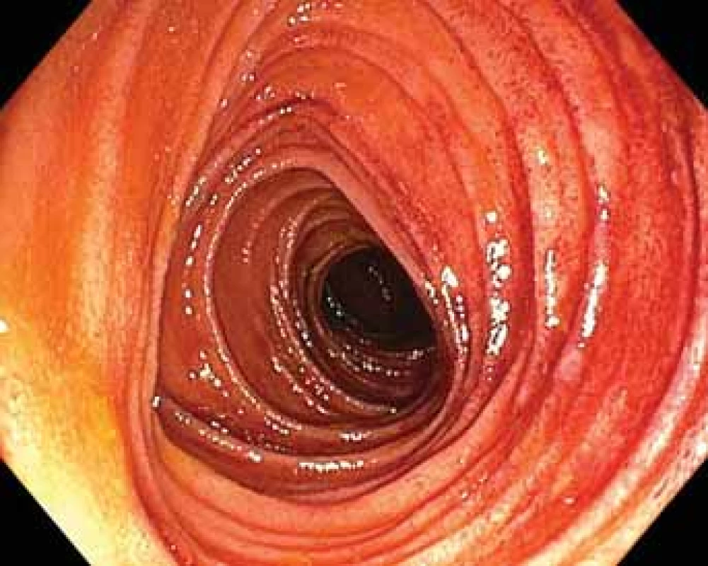 Traumatizovaná sliznice orálního jejuna při extrakci
spirálního enteroskopu.<br>
Fig. 8. Mucosal bruising of the jejunum visualized during extraction of the enteroscope.