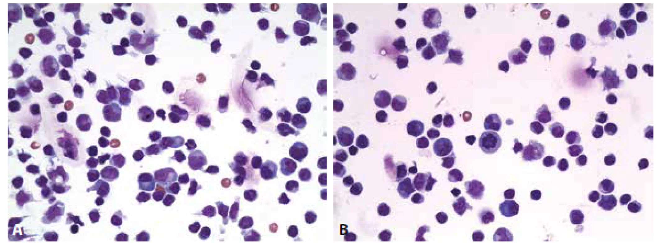 Ilustrační případ 2. Neuroborelióza. (A) Lymfocytární pleocytóza s účastí aktivovaných lymfoplazmocytárních forem a zralých plazmocytů,
monocytů. Malá příměs neutrofilních granulocytů (v centru obrázku). (B) Lymfocytární pleocytóza s účastí aktivovaných lymfoplazmocytárních
forem a zralých plazmocytů, monocytů. V centru pravidelná mitóza.