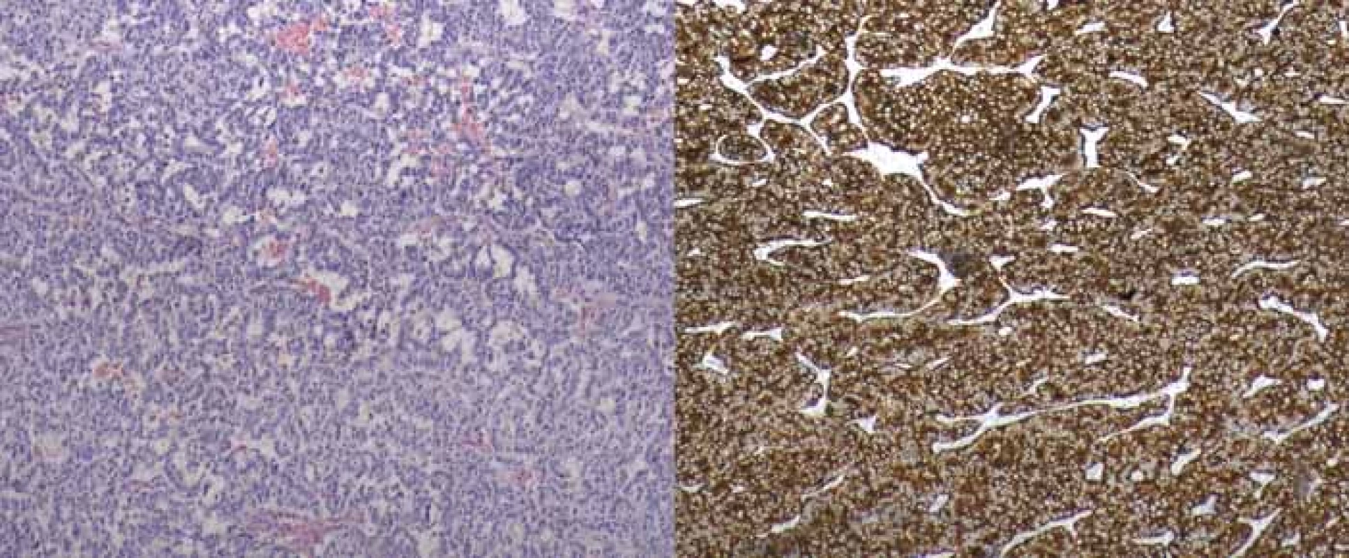 Histologický obraz gatrinomu kaudy pankreatu (WHO 2010 grade 2), vpravo imunohistochemické barvení.<br>
Fig. 4. Histological picture of gastrinoma of pancreatic tail (WHO 2010 grade 2), imunohistochemical staining on the right.