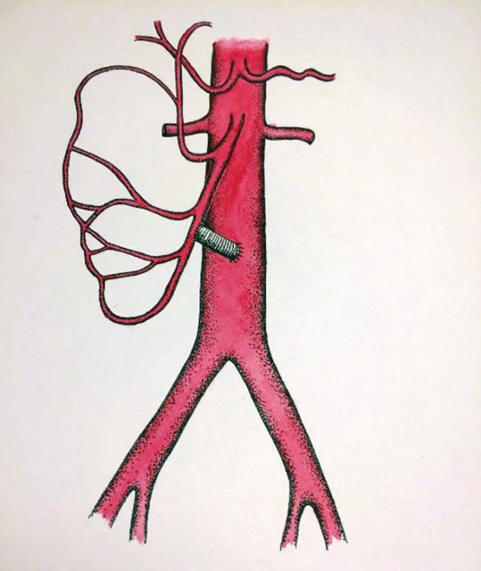 Retrográdní bypass na AMS
(schéma MUDr. Táňa Baráková)<br>
Fig. 7: Retrograde bypass on the superior
mesenteric artery