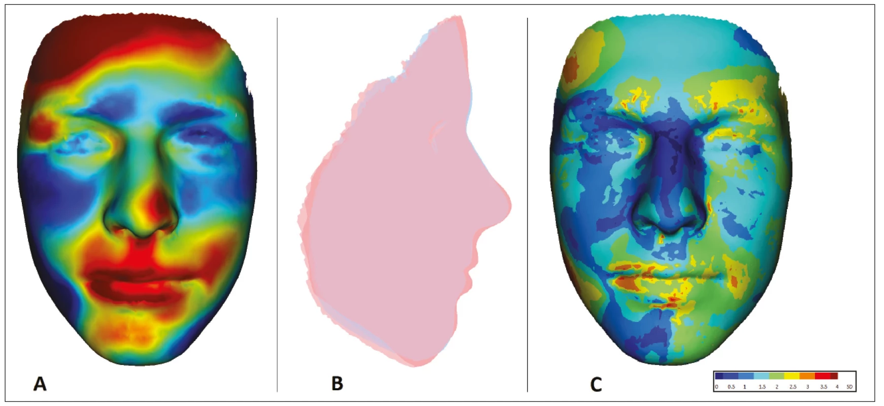 Znázornění oblastí
deformace obličeje
u 15letého pacienta
s OAVS z obr. 3
v porovnání s fyziologickou
normou zdravé populace
odpovídajícího věku a pohlaví<br>
A. porovnání tvaru obličeje:
červeně – oblasti protruze
vůči normě; modře – oblasti
retruze vůči normě;<br>
B. porovnání profi lu obličeje:
červeně – pacient A;
modře – norma;<br>
C. vizualizace odchylek tvaru
obličeje od normy pomocí SD
skóre (obrazová
dokumentace oddělení
ortodoncie a rozštěpových
vad, Stomatologická klinika
FNKV, Praha)<br>
Fig. 4
Visualization of areas of facial
deformation in a 15-year-old
OAVS patient of Fig 3 compared
to the physiological norm
of a healthy population
of corresponding age and sex<br>
A. face shape comparison:
red – protrusion area to
normal; blue – areas
of retrusion to norm;<br>
B. face profi le comparison:
red – patient; blue – norm;<br>
C. visualization of deviations
of face shape from norm using
SD score (Department
of Orthodontics and Cleft
Anomalies, 3rd Faculty
of Medicine, Charles University
and Kralovske Vinohrady
University Hospital)