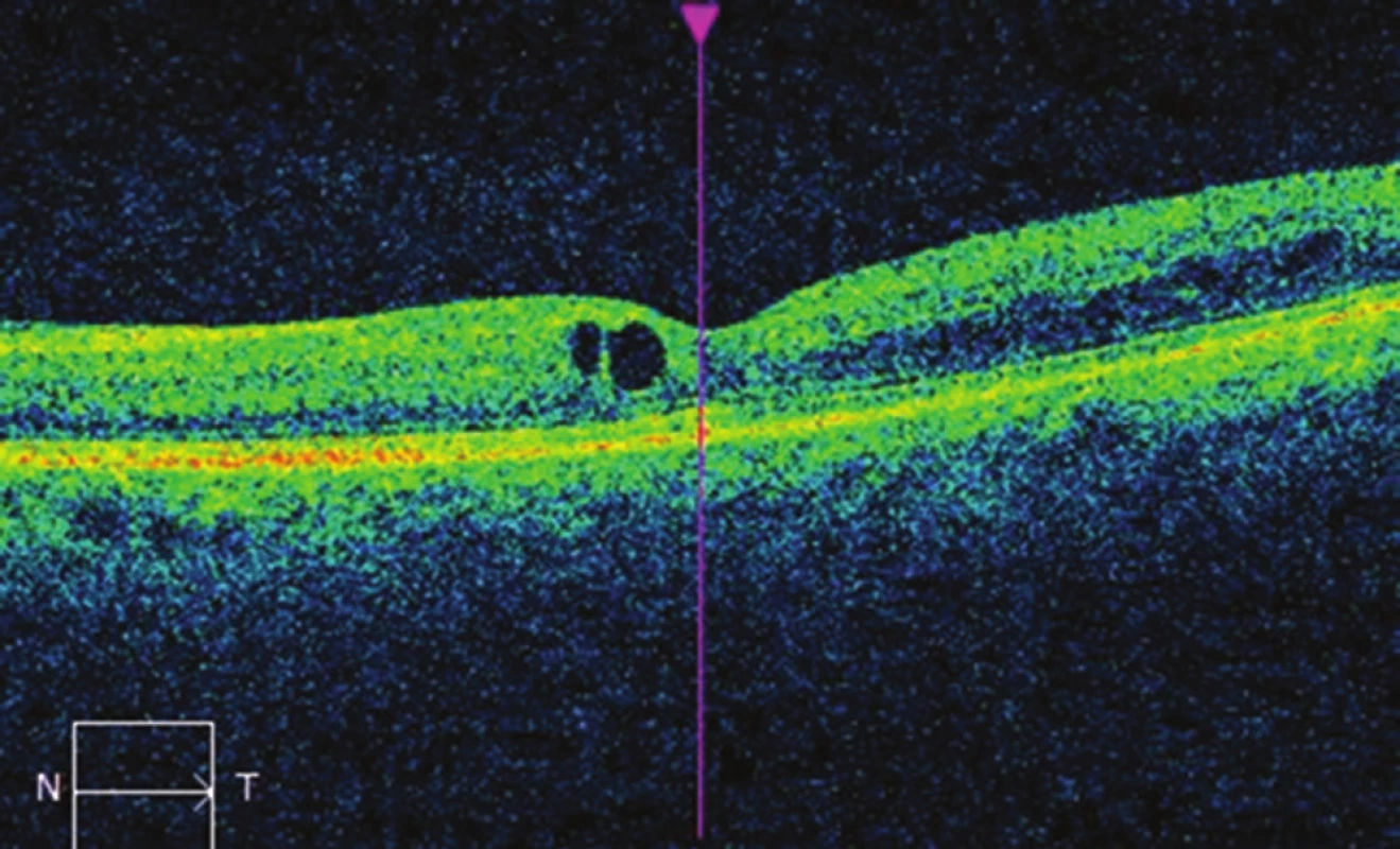 Nález na OCT na levém oku po léčbě mikropulzním laserem:
pokles makulárního edému, CRT 284 μm.