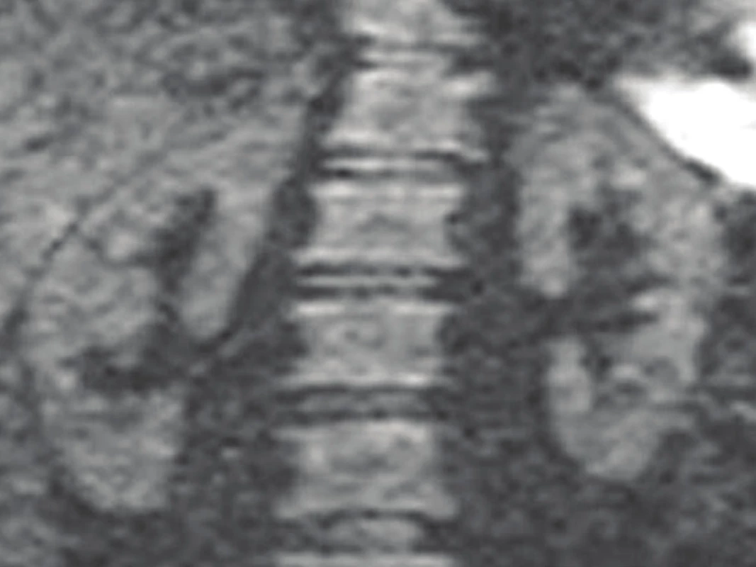 DW-MRI: fyziologický – negativní nález.