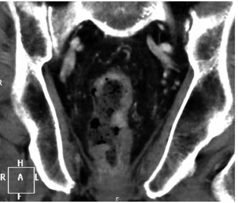Koronární řez CT pánve s infiltrací rekta lymfomem<br>
Fig. 1. Coronal pelvic CT scan with tumorous infiltration
of rectum