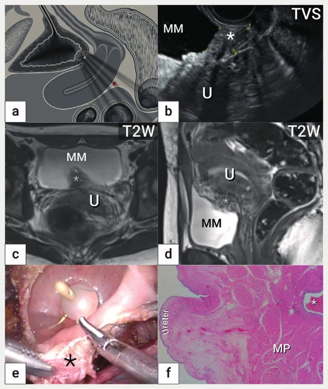 Hluboká endometrióza močového měchýře<br>
Schéma v sagitální rovině s nálezem hluboké endometriózy (označena
hvězdičkou) v bazi močového měchýře (a), léze ohraničena kalipery
(hvězdička) v ultrazvukovém zobrazení v sagitální rovině (b) léze
v magnetické rezonanci v koronární rovině (c) a sagitální rovině (d),
laparoskopická cystotomie s resekcí ložiska hluboké endometriózy
(hvězdička) po zavedení intraureterálních stentů (e), mikroskopický
nález hluboké endometriózy s přítomností endometriálních žlázek
a stromatu (f)<br>
MM – močový měchýř, MP – muscularis propria, U – uterus, TVS –
transvaginální sonografie, T2W – T2 vážené obrazy v magnetické
rezonanci