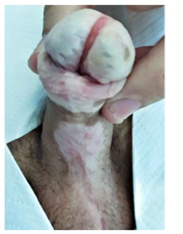 Vzhled dva roky po operaci<br>
Fig. 8. Final appearance two years
after surgery