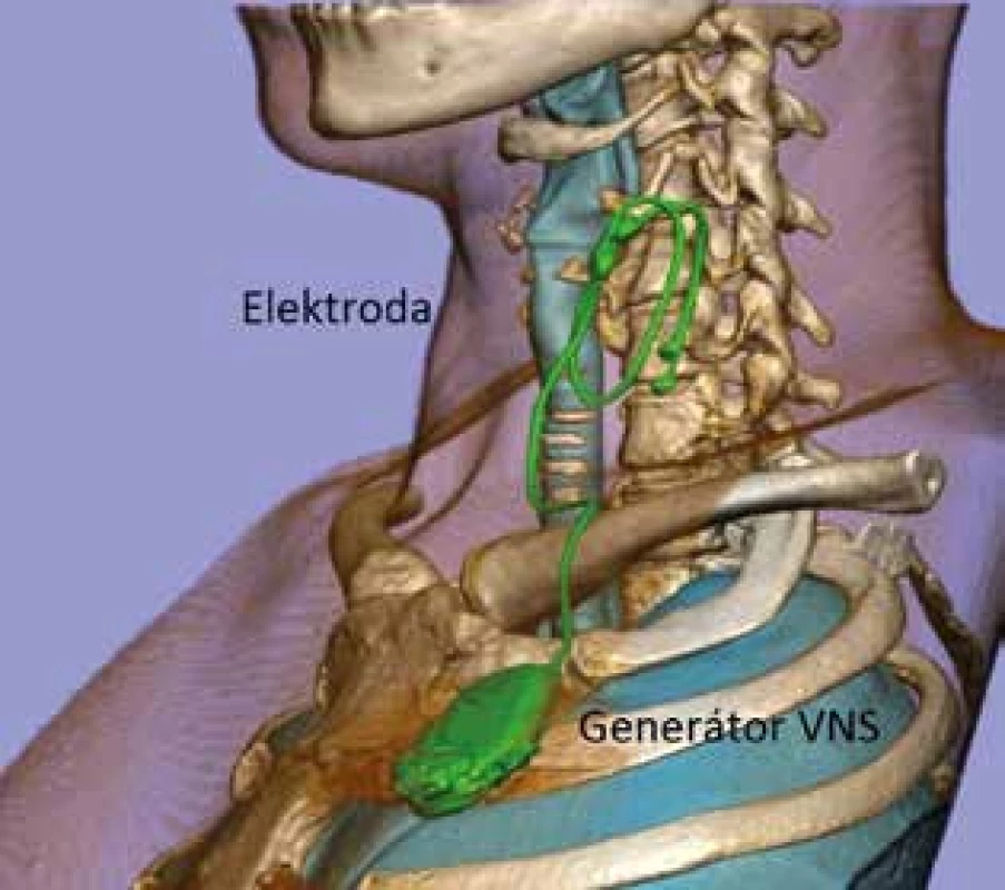 Vagový stimulátor<br>
Fig. 1: Vagus nerve stimulator