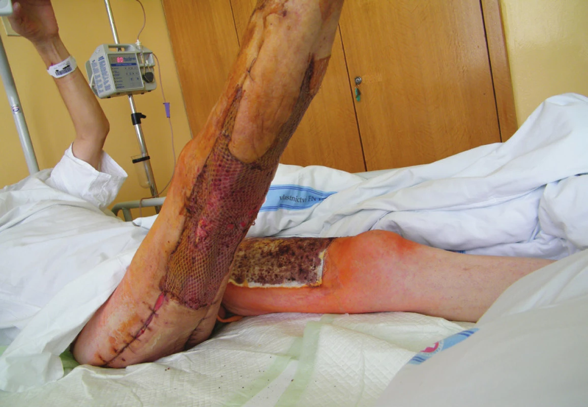 14. den po transplantaci – všechny štěpy přihojeny
(18. 7. 2014)<br>
Fig. 3: 14 days after grafting – all grafts healed in
