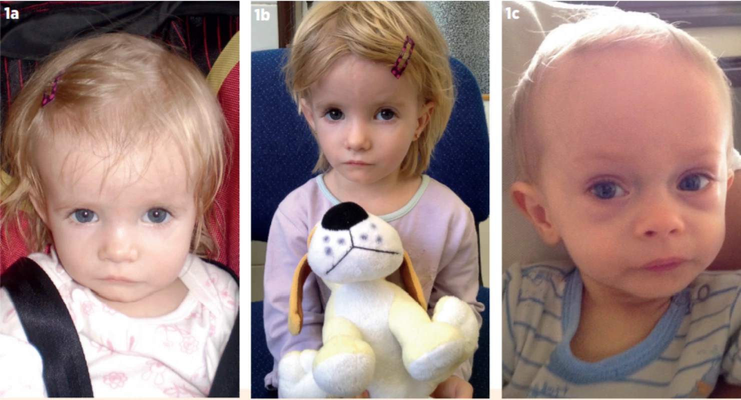 a, b. Dívka se Silverovým-Russellovým syndromem na podkladě hypometylace na chromosomu 11 (11p15-SRS). Narodila ve
38. týdnu těhotenství SGA (small-for-gestational-age) – porodní hmotnost 1700 g, délka 42 cm. I po narození málo
rostla a neprospívala (a – věk 18 měsíců, b – věk 4 roky). 1c) Chlapec se Silverovým-Russellovým syndromem na podkladě mateřské uniparentální disomie krátkého raménka 7. chromosomu (UPD7). Narodil se ve 36. týdnu těhotenství
s hmotností 1900 g a délkou 42 cm (SGA). Od útlého věku byl vyšetřován pro neprospívání, ve věku 1 rok (obr.) vážil
4 kg.<br>
Fig. 1a, b. A girl with Silver-Russell syndrome due to hypomethylation on chromosome 11 (11p15-SRS). She was born at 38th gestational week small-for-gestational-age – with birth weight 1700 g and birth length 42 cm. She failed to thrive and
to grow even postnatally (a – age 18 months, b – age 4 years). 1c. A boy with Silver-Russell syndrome due to maternal
uniparental disomy of short arm of 7th chromosome (UPD7). He was born at 36th gestational week with birth weight
1900 g and birth length 42 cm (SGA). Since early childhood, he failed to thrive and his weight was 4 kg when aged
1 year (fig.)