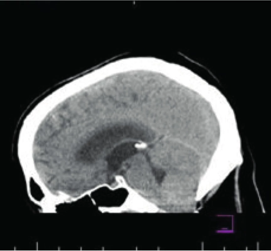 MRI mozgu a cervikálnej chrbtice. Obraz incipientného zápalového
procesu cerebellárnych hemisfér s patologickými signálovými zmenami
prevažne v oblasti kortiko-medulárnej junkcie hemisfér kaudálne a edémom
s protrúziou cerebellárnych tonzíl do foramen magnum a incipientným
3-komorovým hydrocefalom s naznačeným miernym transependymálnym
prienikom likvoru