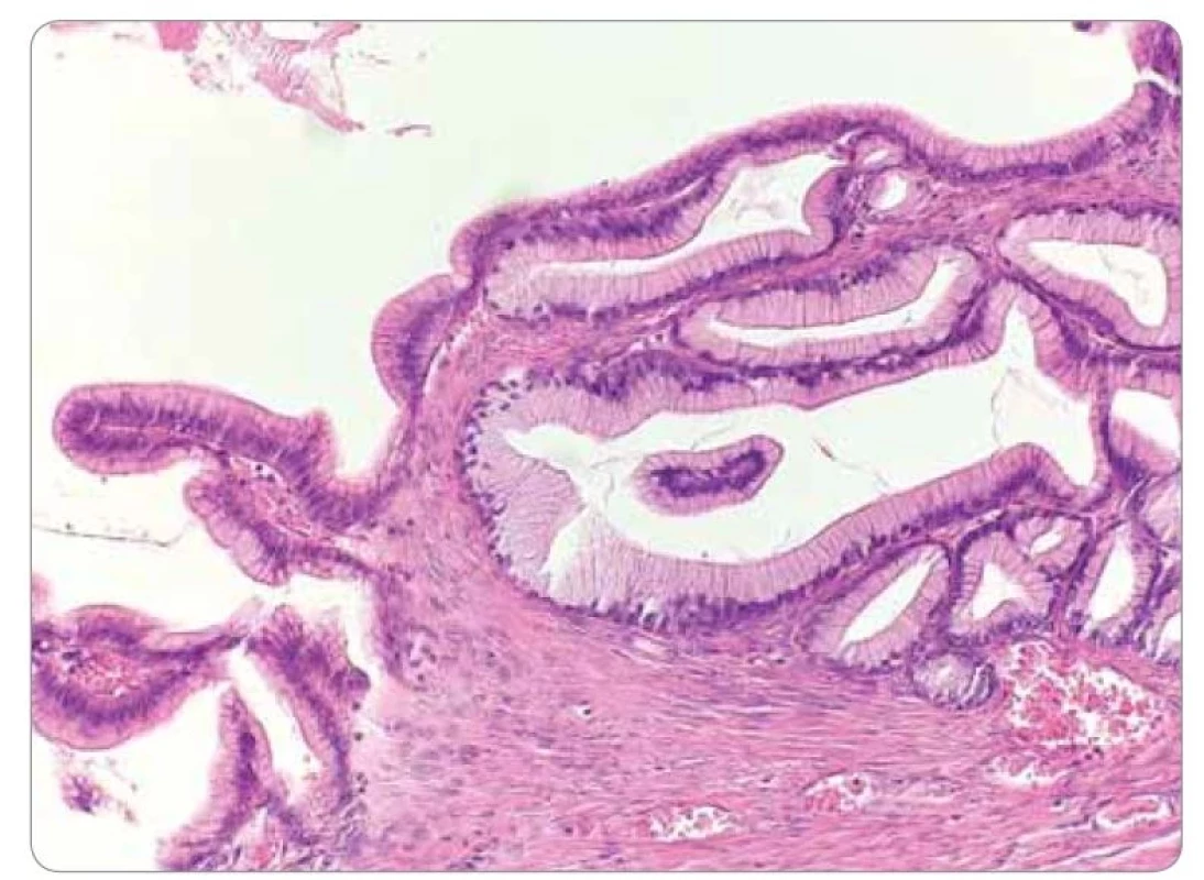 Detail na nádorový epitel bez atypií (farbenie hematoxylín & eozín, zväčšenie
40×).