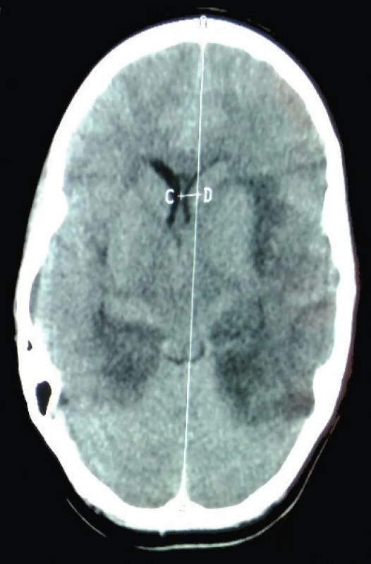 CT mozgu. 9. deň ochorenia: Obraz encefalitídy obojstranne, herniácia falxu doprava. <br>
Fig. 2.  CT of brain. 9th day of illness: Picture of encephalitis on both sides, hernia falx to the right.