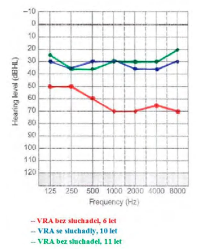 Výsledky měření pomocí VRA
u pacientky v kazuistice č. 2. Červená
křivka představuje prahovou křivku
slyšení z VRA vyšetření v 6 letech dítěte.
Modrá křivka udává ziskovou křivku
se sluchadly. Zelená křivka představuje
prahovou křivku sluchu v 11 letech věku