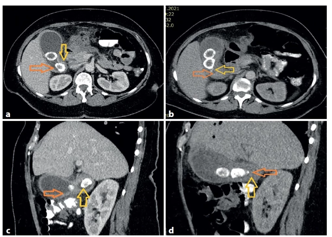 (a−d): CT obrazy pacientky po příjmu (vlevo) a po epizodě hemobilie (vpravo)<br>
Na časnějším vyšetření je patrný konkrement vyplňující Hartmannovu kapsu (žlutá šipka) a obsah žlučníku charakteru
hydropsu (oranžová šipka). Na kontrolním snímku se poloha konkrementů změnila (žlutá šipka) a obsah ve
žlučníku je více denzní, nehomogenní (oranžová šipka), což naznačuje možnost přítomnosti koagul.<br>
Fig.1 (a−d): CT scan of the patient at the time of admission (left) and after the hemorrhagic episode (right)<br>
The picture taken earlier shows a stone filling the Hartmann pouch (yellow arrow) and the content of the bladder
which seems to be hydropic (orange arrow). In the later picture, the stones moved (yellow arrow) and the content
of the bladder is denser, non-homogeneous (orange arrow), indicating the possible presence of blood clots.