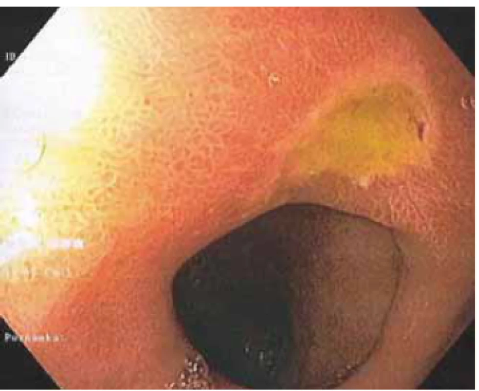 picture of ulcer on
the upper side of the prepyloric area.<br>
Obr. 1. Endoskopický obraz vredu na
hornej strane v prepylorickej oblasti.