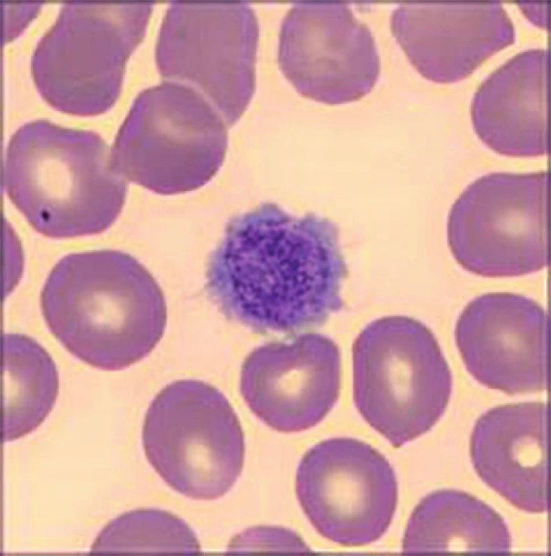 Makrotrombocyt u pacientky se Sebastianovým syndromem.
Barvení May-Grünwald a Giemsa-Romanovski, zvětšení 100×