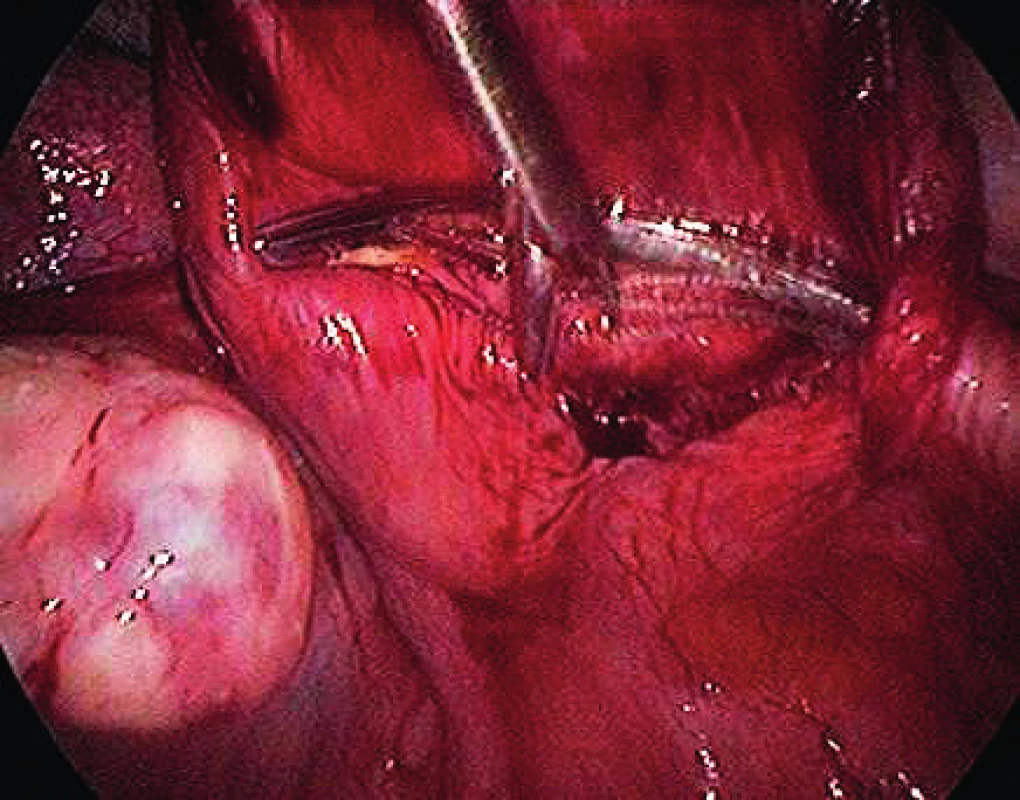 Extraction of the implant from Serapro RTD on vaginal
stump