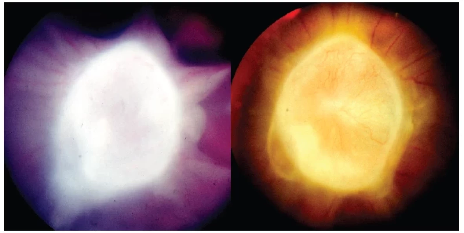 Vlevo: Cystický granulom hlavy zrakového nervu toxokarové etiologie s vitreálními
pruhy před celkovou terapií
Vpravo: Cystický granulom hlavy zrakového nervu toxokarové etiologie s kapilárami na
jeho povrchu půl roku po kombinované léčbě