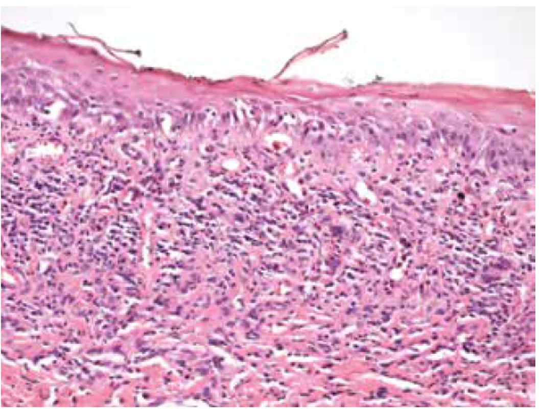 Histologický vzorek z ložiska v dutině ústní
u pacientky, odběr v roce 2011. Dlaždicobuněčný epitel
sliznice dutiny ústní s vrstvou parakeratózy, vakuolární
degenerací, v subepitelovém pojivu pásovitý lymfocytární
infiltrát typický pro lichen planus