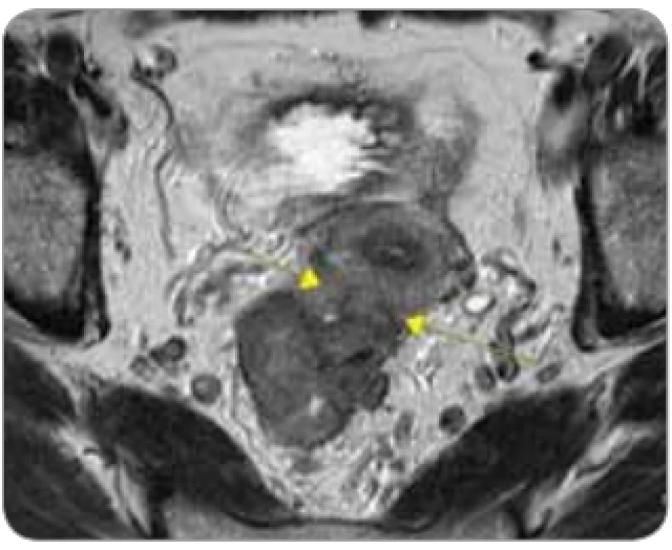 „Ugly“ tumor u pacientky s tumorózní infi ltrací stěny rekta s přerůstáním
do dělohy ventrálně, cT4b N2 M0.
