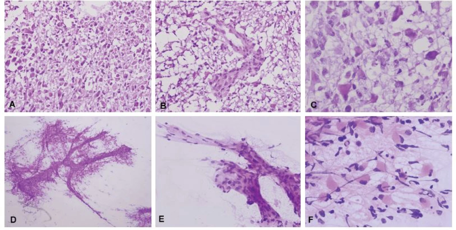 (A) Biopsia tumoru temporálne vpravo u 59-ročného muža. Radiologicky suspekný high-grade glióm. V zmrazených rezoch bol zachytený hypercelulárny
tumor tvorený atypickými bunkami s objemnou cytoplazmou. (B) Mikrovaskulárna proliferácia. (C) Detail cytologických atypií v zmrazenom reze, prítomné
boli početné mitózy. (D) V náterovej cytológii bolo možné pozorovať abnormálne cievy (mikrovaskulárna proliferácia), ku ktorým boli gliálnymi výbežkami
pripojené nádorové bunky. (E) Detail mikrovaskulárnej proliferácie. (F) Atypické bunky s gemistocytickou morfológiou na fibrilárnom pozadí. Peroperačná
diagnóza: high-grade glióm – glioblastóm. Definitívna diagnóza: Glioblastóm, Grade IV.