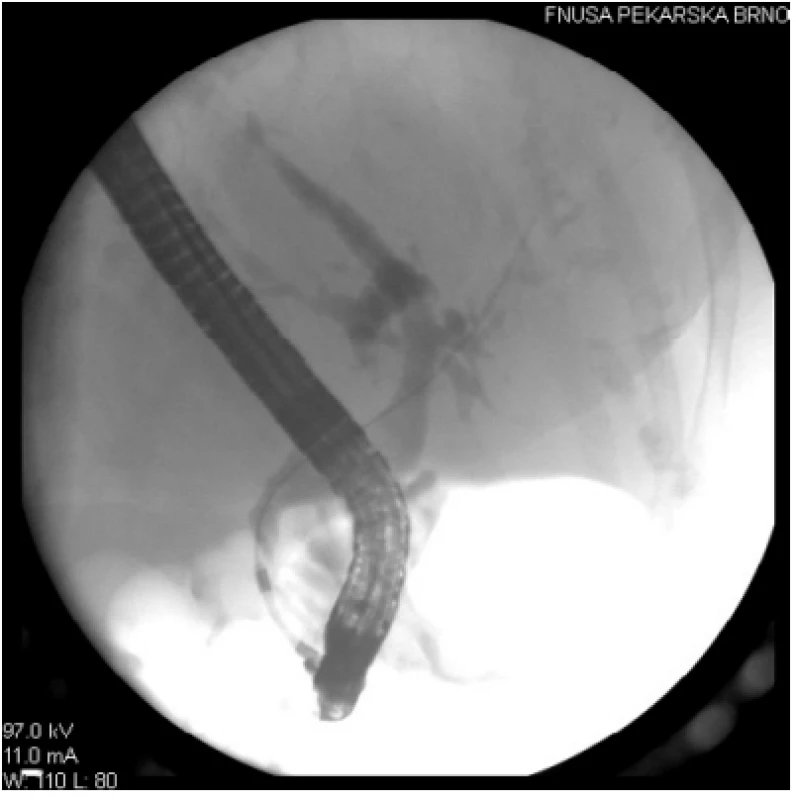 Na tomto RTG obraze je patrné, že po endoskopické extrakci choledocholitiázy jsou žlučové cesty již zcela volné