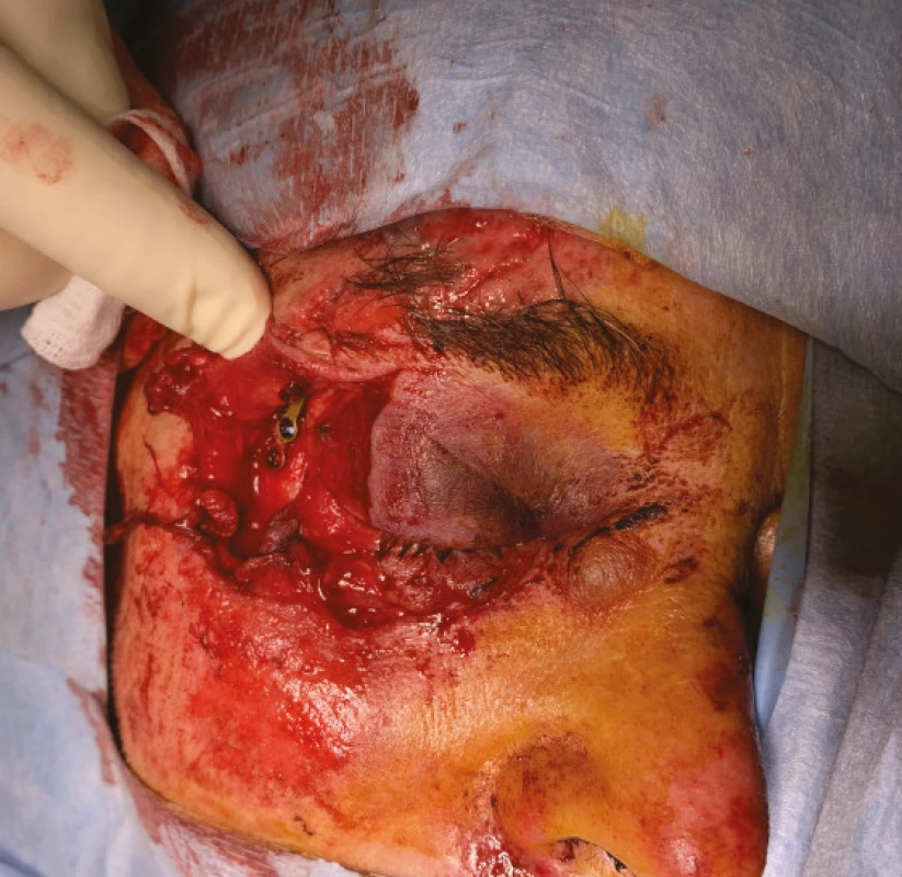 a. Severe injury to orbit and eyelids in traffic accident. Performed reconstruction of the fracture of the outer wall of the
orbit by a stomatosurgeon is visible