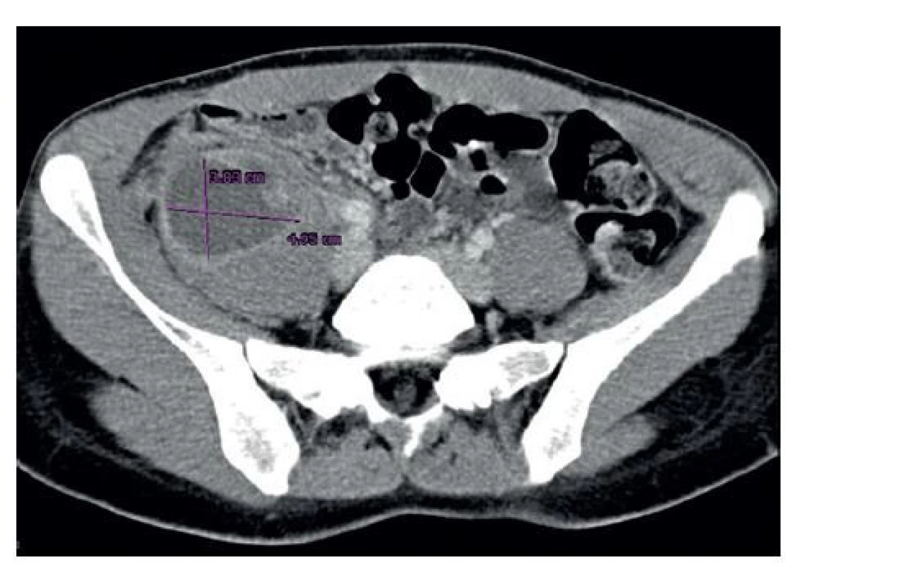 Kontrastné CT vyšetrenie (axiálna projekcia) s nálezom
retroperitoneálneho abscesu vpravo<br>
Fig.1: Contrast CT scan (axial plane) with the finding of
a retroperitoneal abscess on the right