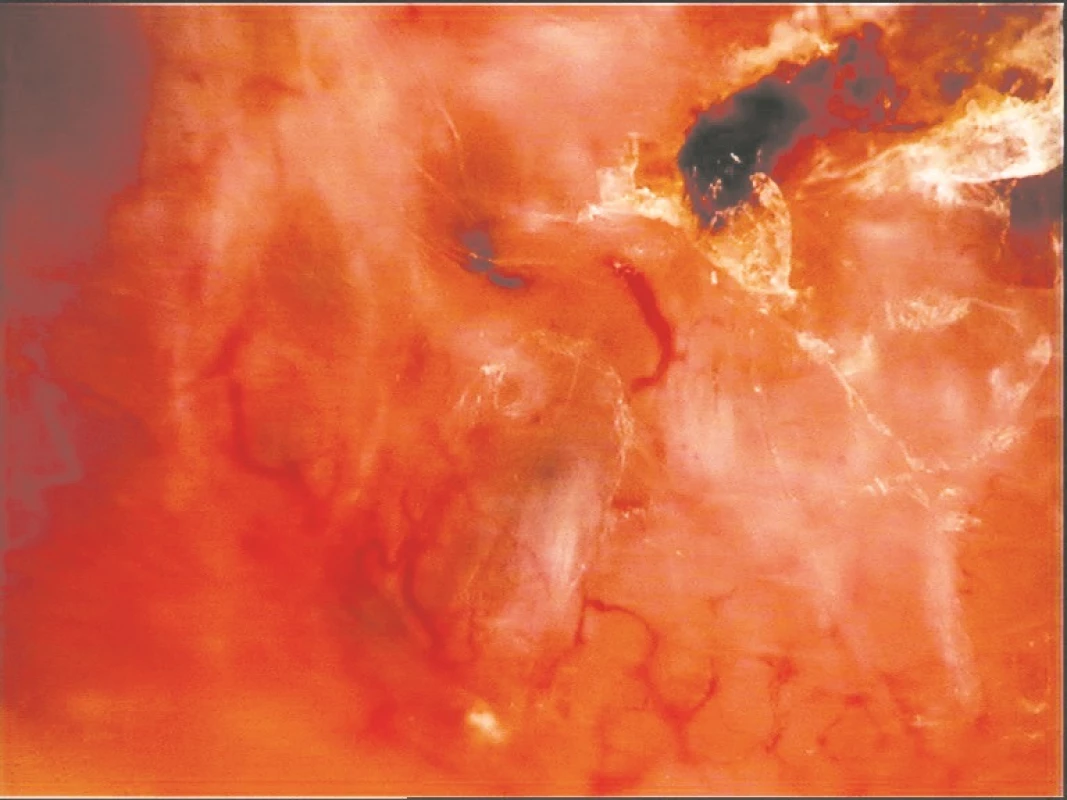 Ovoidní struktury, ulcerace, arborizující cévy – nodulární
cystický bazaliom
