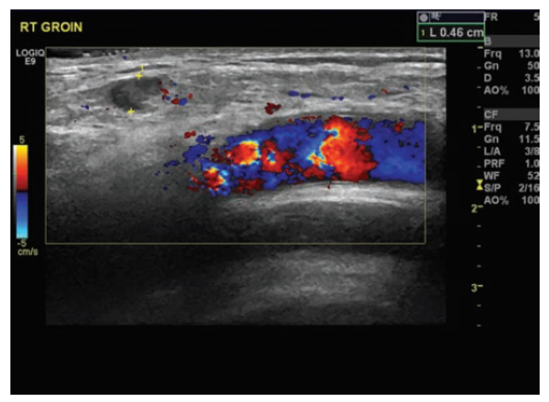 Ultrazvuk pravé kyčle zobrazující cystu a vztah
k velkým cévám<br>
Fig. 3: US right groin showing cyst and its relation to big
vessels