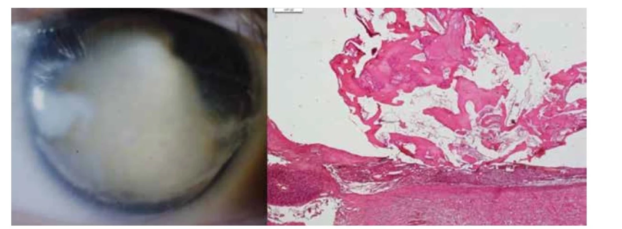 Vlevo: Ftíza bulbu po toxokarovém zánětu<br>
Vpravo: Osifikovaná cysta po hlístu v cévnatce, HE, zvětšení 20x