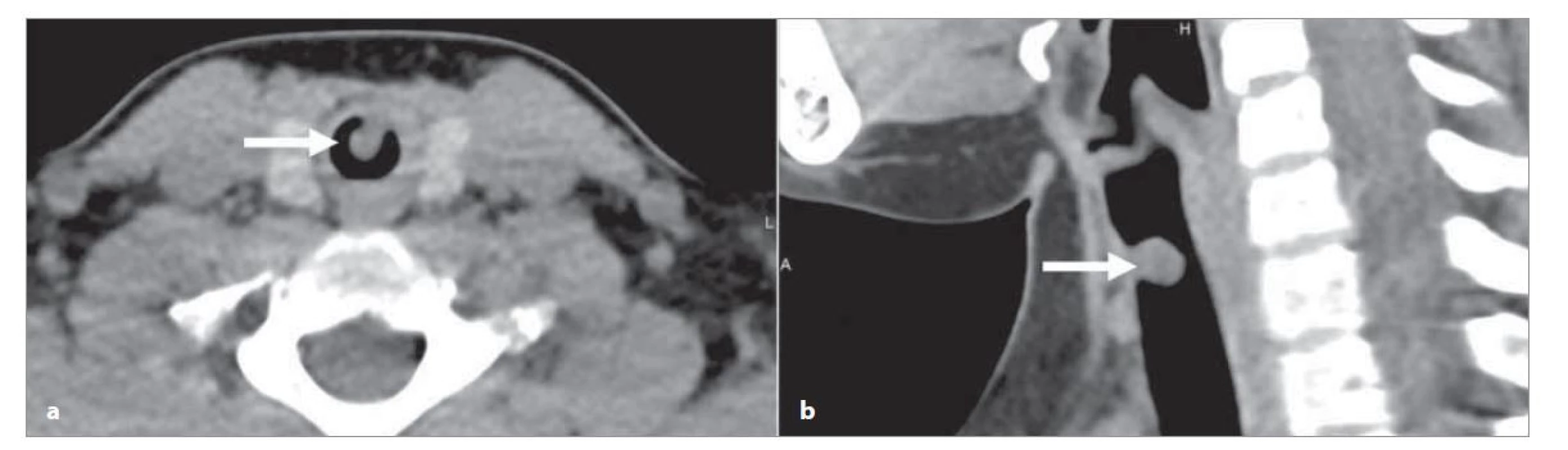CT krku a hrudníku – polypózní útvar na ventrální stěně průdušnice (šipka).<br>
a) axiální rovina, b) sagitální rovina.<br>
Fig. 1. CT of the neck and chest – polyp on the ventral wall of the trachea (arrow).<br>
a) axial plane, b) sagittal plane.