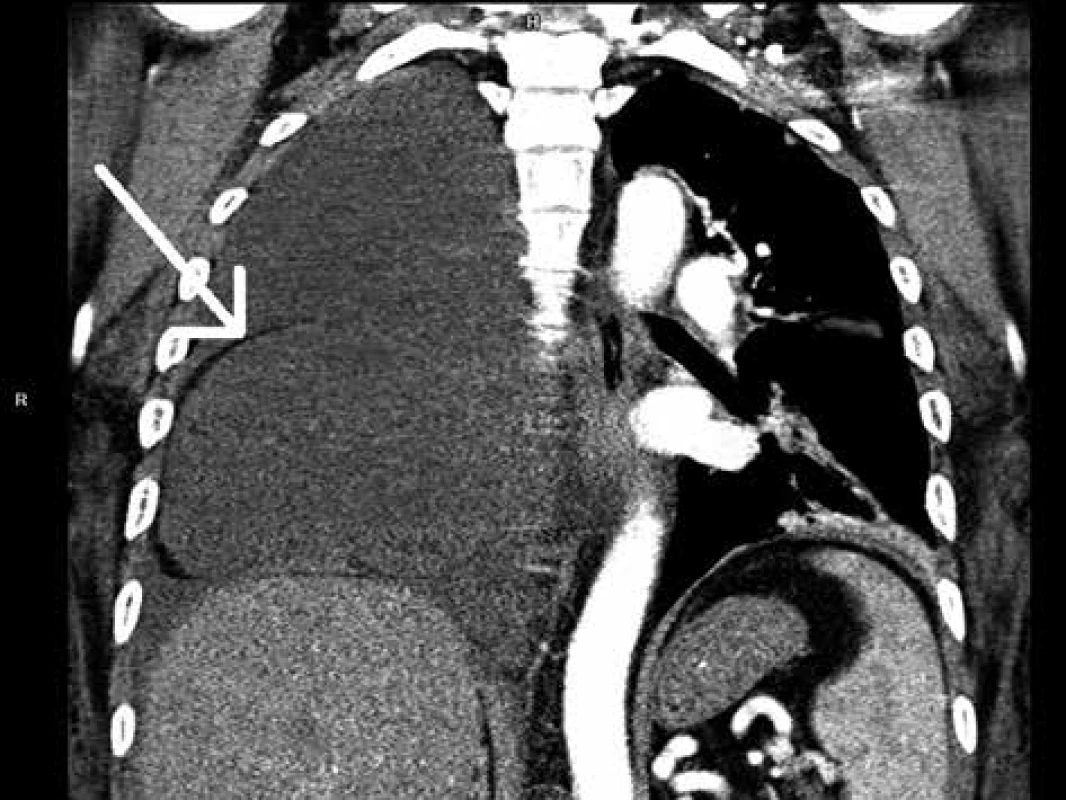 CT hrudníku, kde je patrný kýlní vak vyplněný tekutinou a fluidotorax vpravo<br>
Fig: 3: CT scan of the chest with the hernia sac filled with
fluid and right-sided fluidothorax