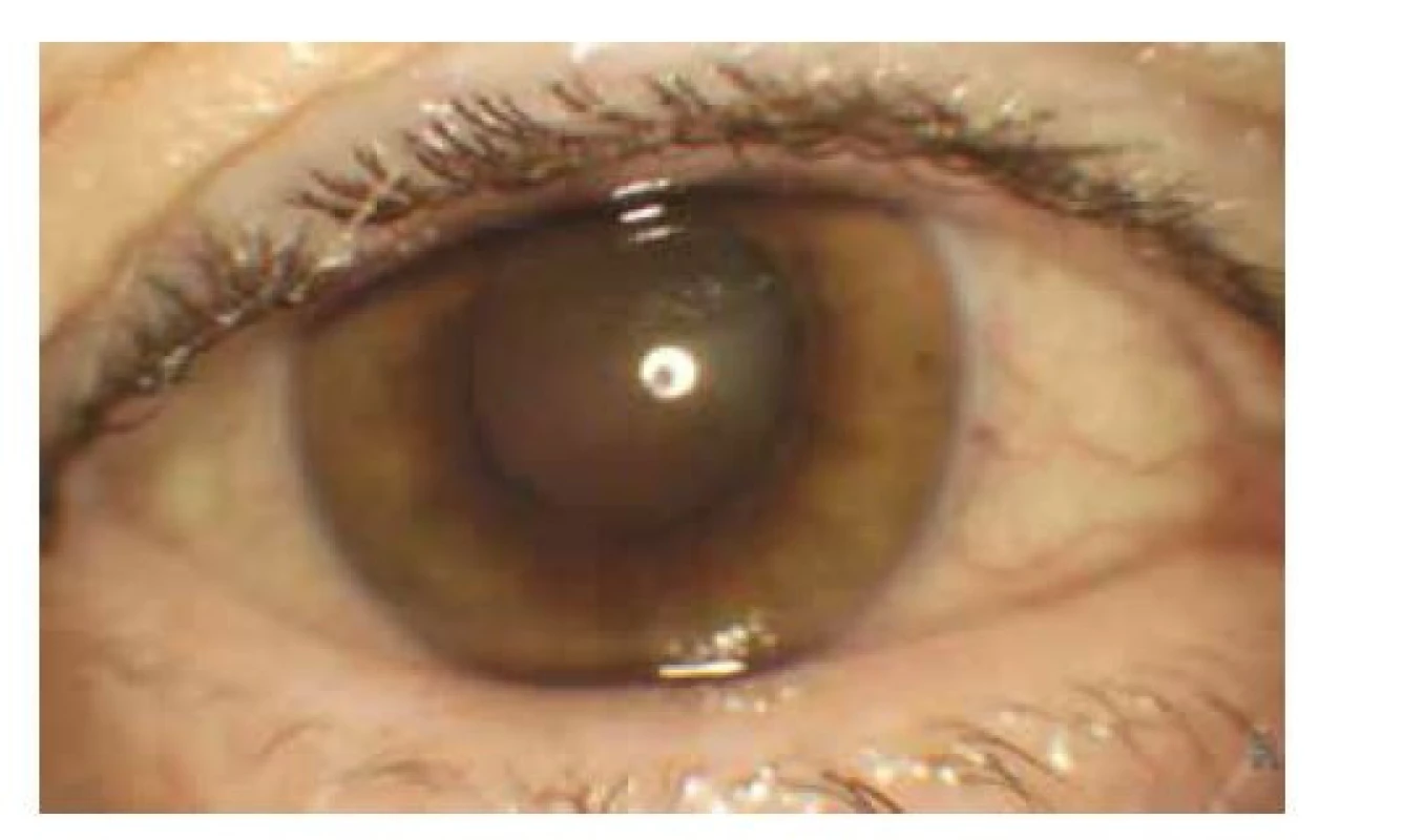Fotografia predného segmentu pravého oka: absencia
červeného reflexu, precipitáty na endoteli rohovky a prednom
púzdre šošovky