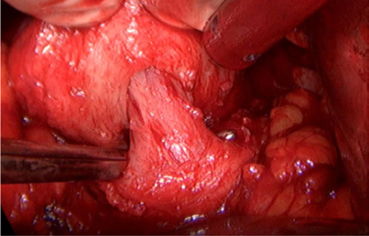 Detail uvolněného hrdla bez použití koagulace<br>
Fig. 2. Detail of dissected bladder neck without using
coagulation