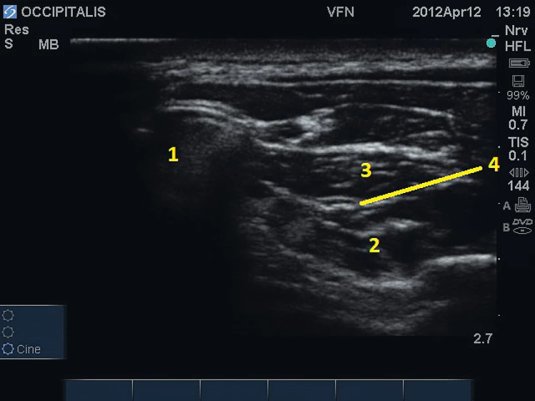 Blokáda nervus occipitalis major pod
ultrazvukovou kontrolou. 1 – obratel C2, 2 – m. obliquus capitis
inferior, 3 – m. semispinalis, 4 – n. occipitalis major