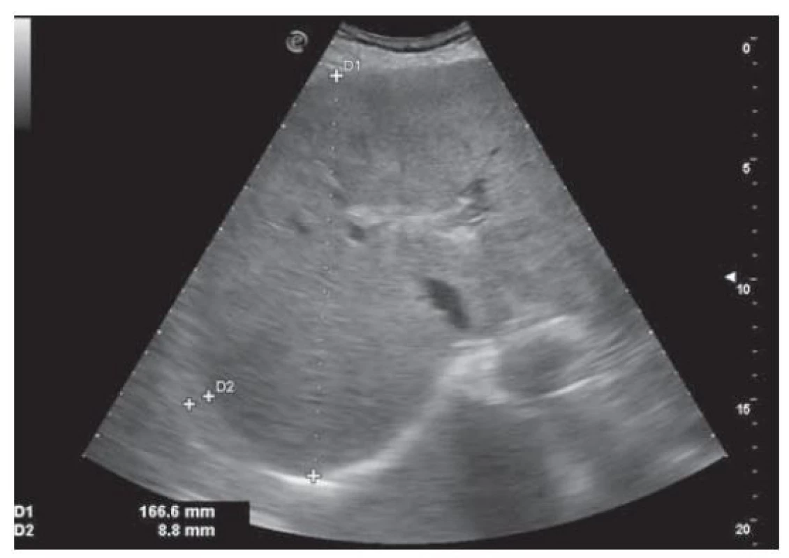 USG nález steatózy heparu s hepatomegáliou
a perihepatálnym ascitom.<br>
Fig. 1. USG finding of liver steatosis with hepatomegaly and
perihepatic ascites.