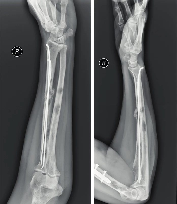 Woman, 62 years old, right forearm x-ray in AP and lateral projection, osteosynthesis of diaphyseal radial fracture with intramedullary inserted Prevotʼs rods is captured