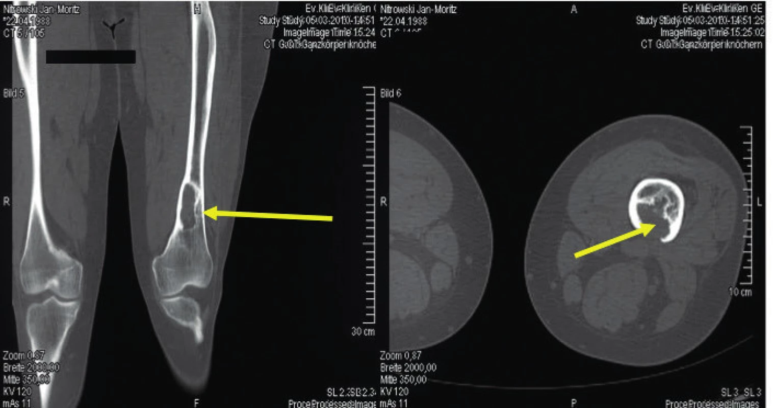 Osteolytické ložisko ve femoru narušující kortikalis<br>
Snímek zapůjčil pro tuto publikaci prof. Claus Doberaurer
z Gelsenkirchenu, Německo.