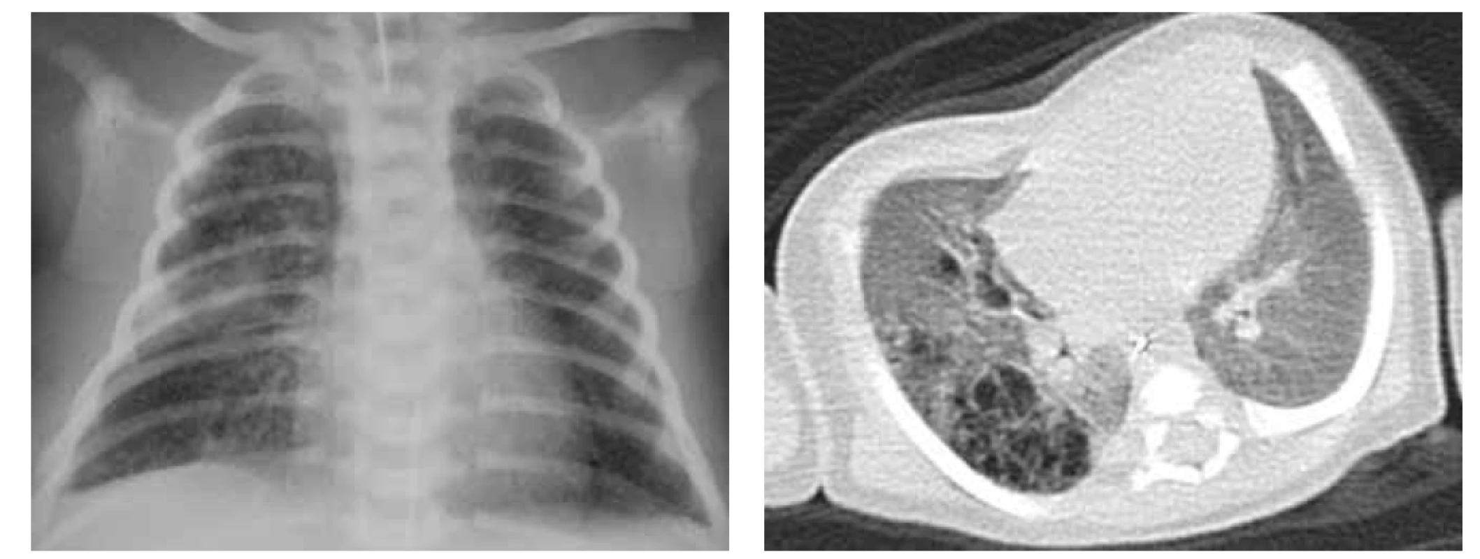 A. RTG plic, CPAM pravé plíce prenatálně diagnostikovaná, známky RDS.<br>
Fig. 3A. Chest X-ray, CPAM in the right lung, diagnosed prenatally, features of RDS.<br>
Obr. 3B. CT hrudníku, transverzální řez, difuzní postižení pravé plíce při CPAM typu 2 v.s.<br>
Fig. 3B. Chest CT scan, transversal cut, diffuse involvement of the right lung by CPAM type 2.