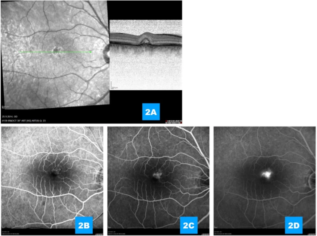 (A) Complicating minor classic portion of secondary choroidal neovascularisation 1 month after performed photodynamic therapy
(B, C, D) Demonstration of highly active choroidal neovascularisation on fluorescence angiography