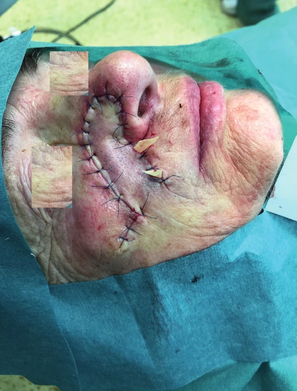 Condition after insertion of the nasolabial flap into the defect (author’s archive)