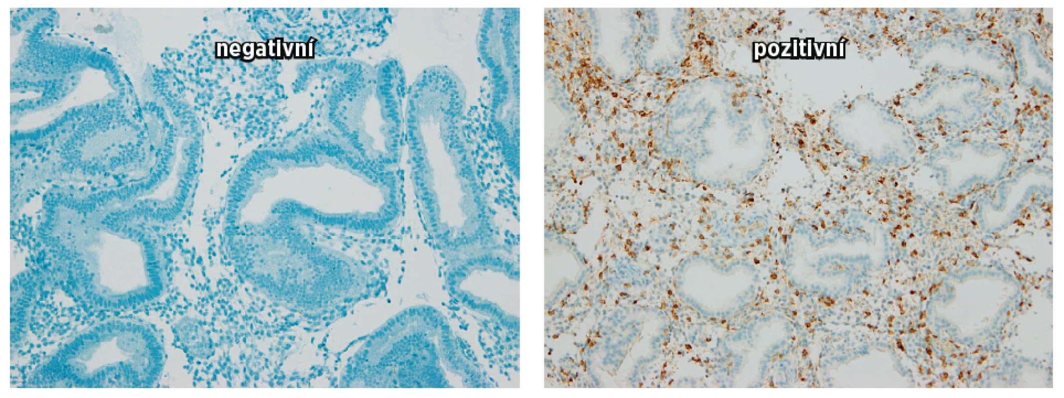 Obrázek vyjadřuje denzitu NK buněk CD56+ v endometriu (negativní a pozitivní)