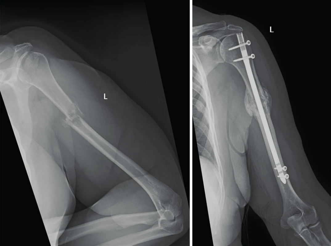 Woman, 78 years old, left humerus x-ray of  24.11.2016 shows pathological fracture of diaphysis in the osteolytic deposit field. X-ray of the left humerus of the same patient of 26.10.2017 shows performed stabilisation of the fracture with an intramedullary nail which is the stage of healing by bony callus