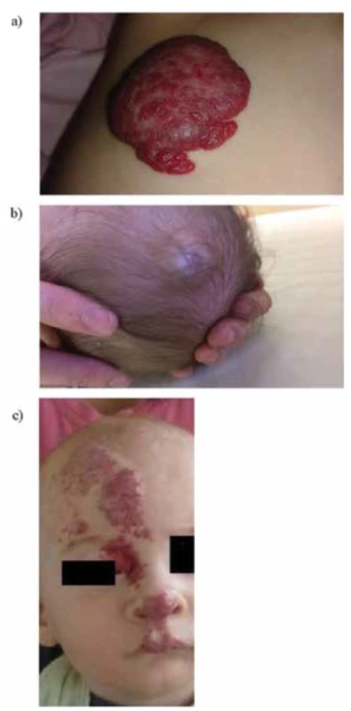 Rozdelenie infantilných hemangiómov (IH) na základe
hĺbky postihnutia kože (zdroj: archív autorov).<br>
a) Povrchové (kapilárne) IH<br>
b) Hlboké (kavernózne) IH<br>
c) Zmiešané (kapilárno – kavernózne) IH<br>
Fig. 2. Classification of infantile hemangiomas (IH) based on
the depth of the lesion from the skin surface (source: authors’
archive).<br>
a) Superficial (capillary) IH<br>
b) Deep (cavernous) IH<br>
c) Mixed (capillary-cavernous) IH