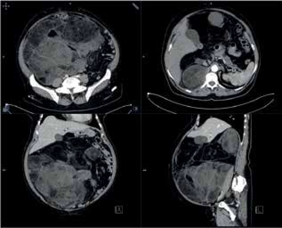 CTA obraz tumoru <br>
Fig. 10: CTA scan of the tumor