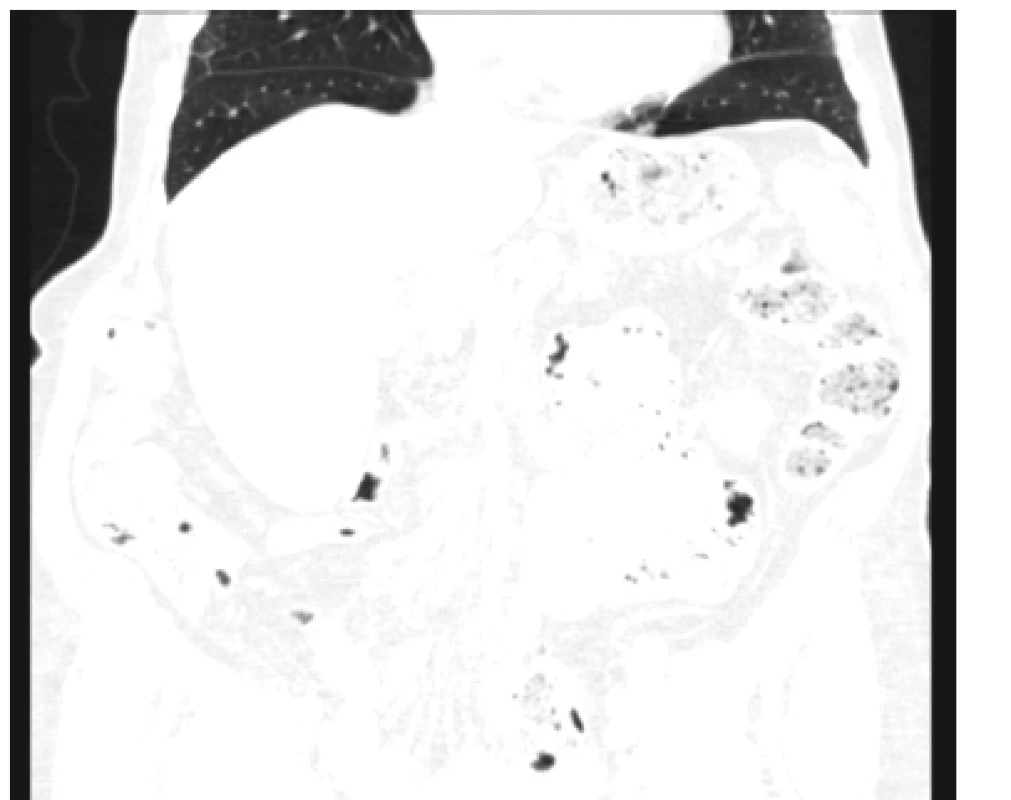 CT ledvin v 3/2019 – zjevně zcela normální nález
na zachycené části plic, bez plicního postižení